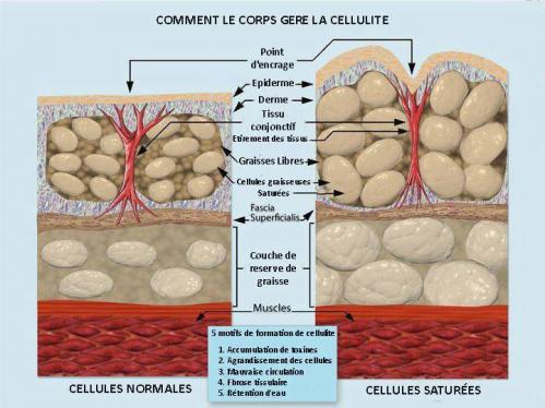 Cellulite 3