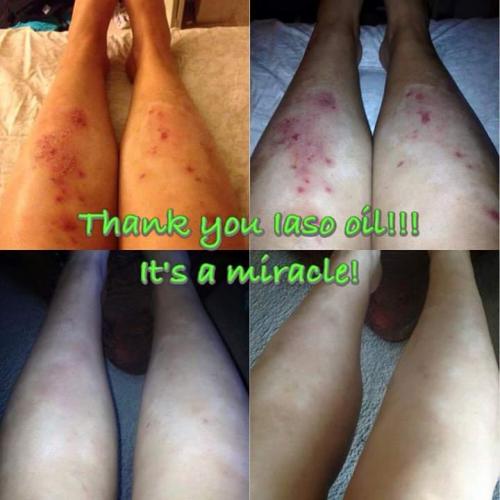 Iaso oil psoriasis