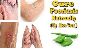 Psoriasis et aloe vera