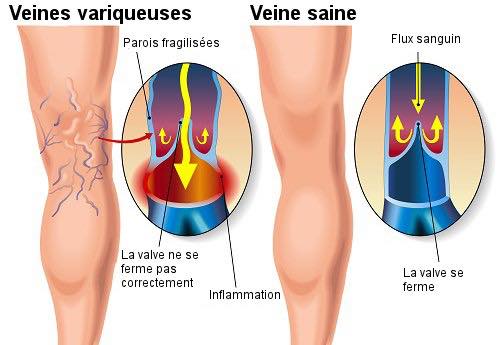 studii instrumentale în varicoza homeopatie varicoza sarcina